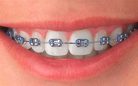 precio de brackets metalicos en peru|precio de brackets de zafiro.